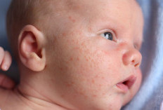 Viral Exanthem, Penyakit Ruam Pada Anak Akibar Virus, Kenali Gejala dan Cara Mengobatinya Disini!